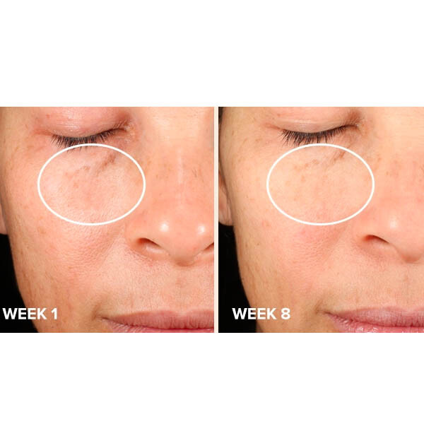 PAULA'S CHOICE Clinical Discoloration Repair Serum Melasma Hyperpigmentation before after results
