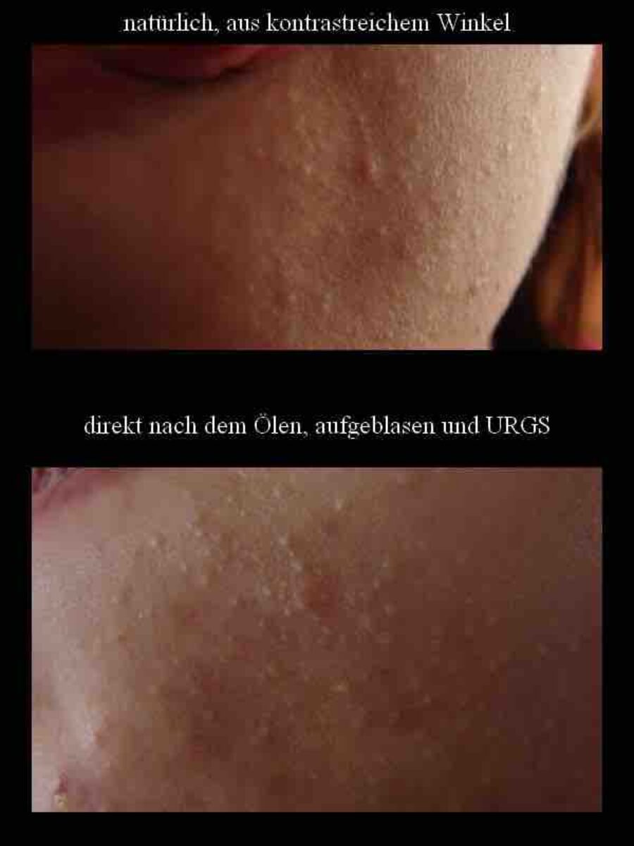 Hautproblem Bläschen Knubbel Komedonen am Kinn